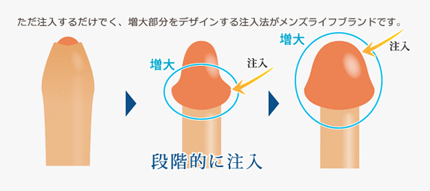 Plan②：亀頭増大・陰茎増大