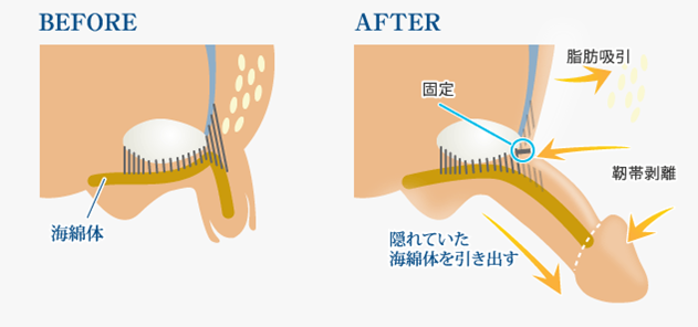 Plan③：長茎手術(短小治療)