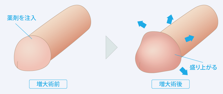 治療プラン③：亀頭増大術