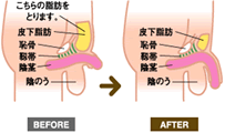 ボディジェット法