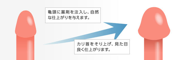 治療プラン②：亀頭・陰茎増大術