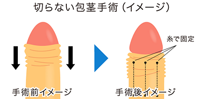 切らない包茎手術