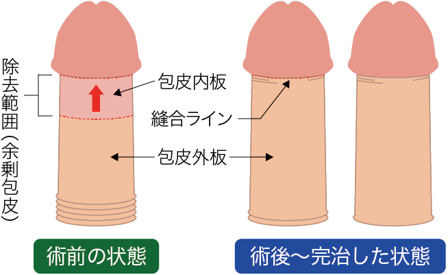 亀頭直下埋没法