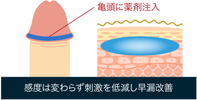 治療プラン②：早漏対策