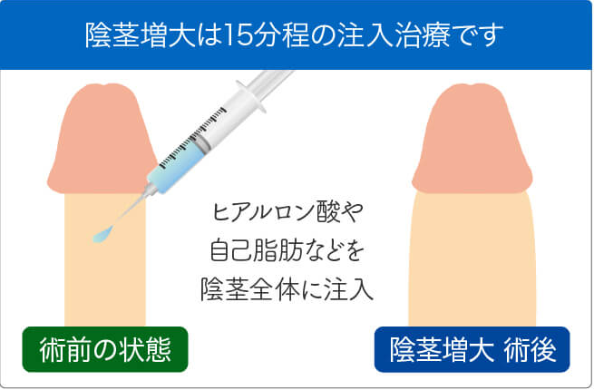 治療プラン⑤：陰茎増大
