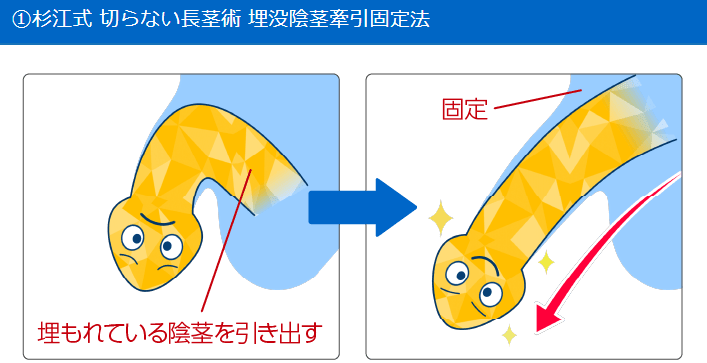 切らない長茎術