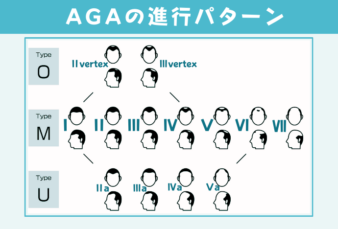 AGAの進行パターンは7段階