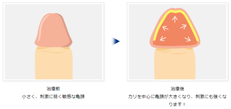 青山セレスクリニックの亀頭増大術