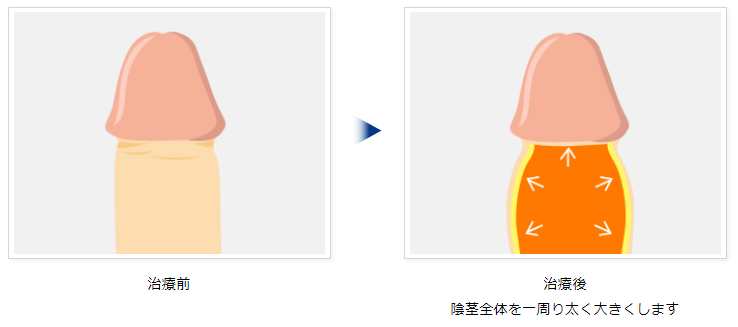 青山セレスクリニックの陰茎増大術