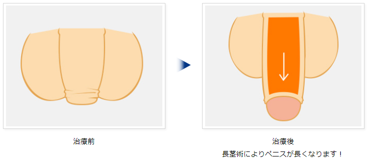 青山セレスクリニックの長茎術