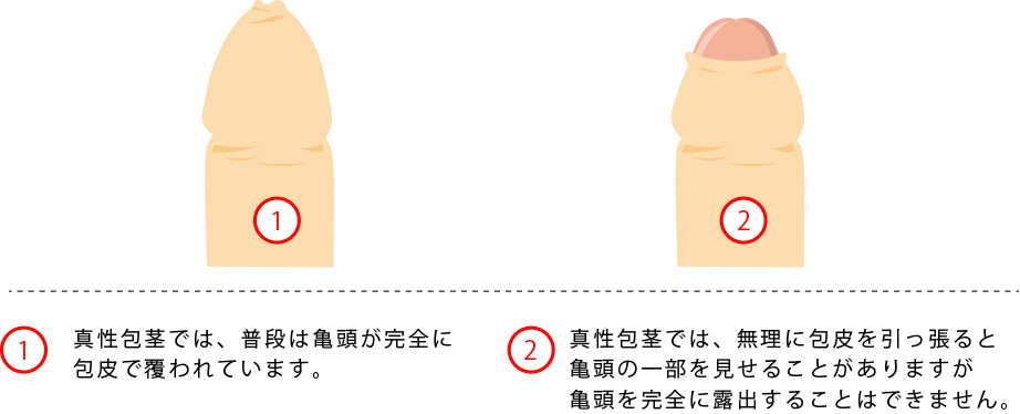 青山セレスクリニックの真性包茎治療