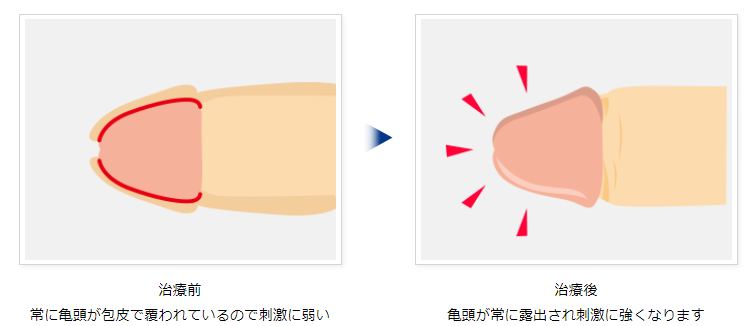 青山セレスクリニックの仮性包茎治療