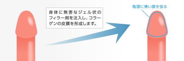 皐月クリニックの早漏防止術