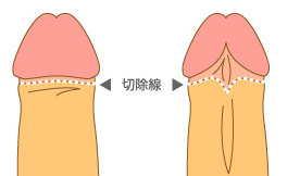 東京上野クリニックの包茎治療